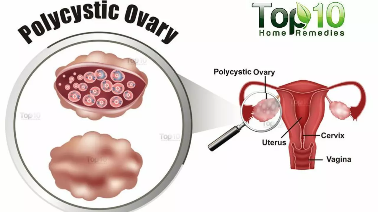 The Role of Alfacalcidol in Managing Polycystic Ovary Syndrome (PCOS)